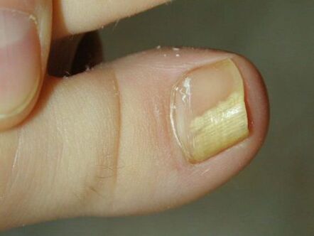ciuperca unghiilor arată ca stadiul inițial)